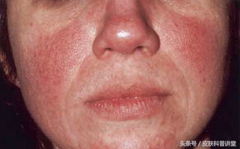 酒渣鼻(玫瑰痤疮)的诊断及治疗专家共识