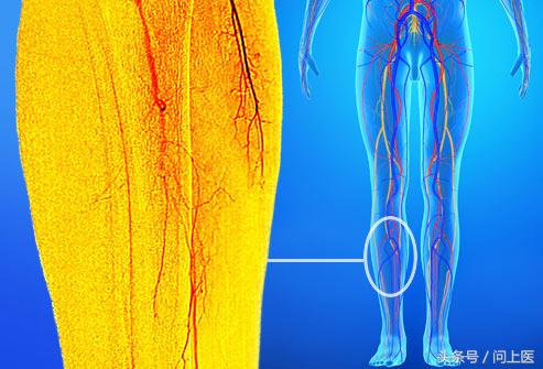 该疾病患者的四肢(通常是双腿)中缺乏足够的血液,其常见原因是动脉
