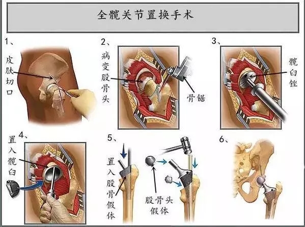 股骨头置换手术是怎么回事，看着都疼！有哪些后遗症？