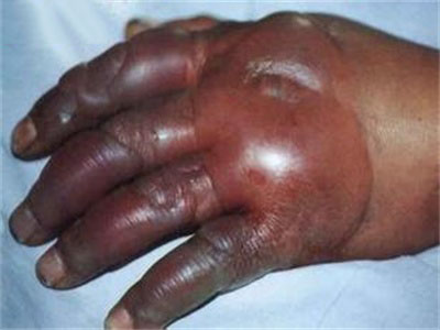 从轻微冻疮恶化成三级冻疮有多可怕?