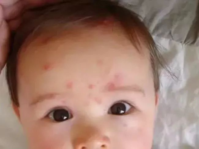 每个孩子都要出水痘？不用怕，妈妈可以这样做！