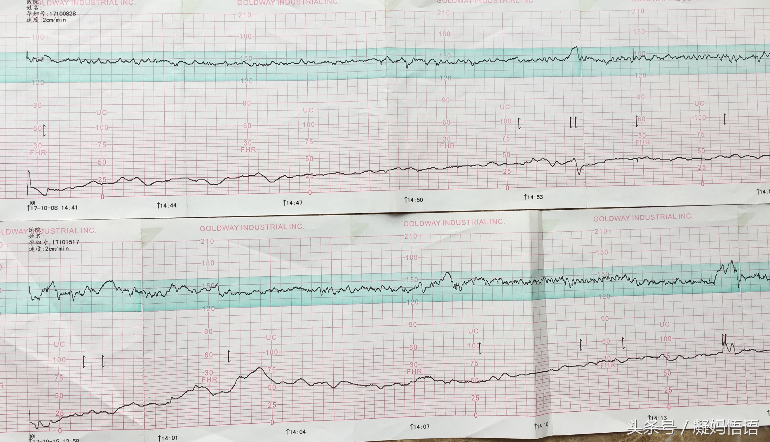 三次胎心监护结果分享：几个小心得，教你胎心监护做到10分