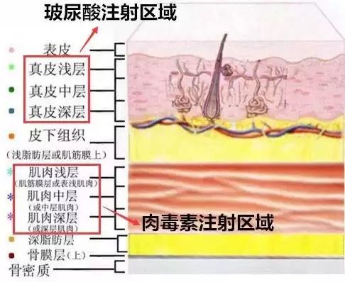 天呐，脸上又长皱纹了？赶紧打针除皱针压压惊