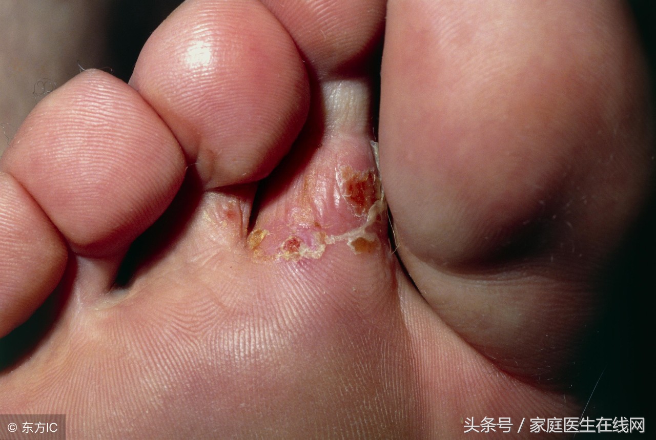 脚气（足癣）如何彻底根治？与脚气病完全不同