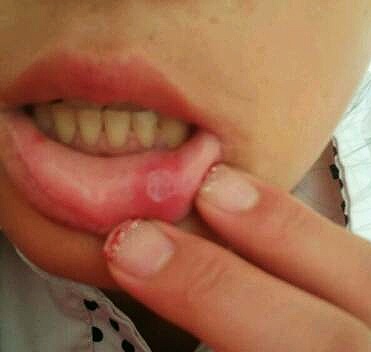 口舌总是生疮溃疡，别总用“上火”来敷衍！太医世家送来一方