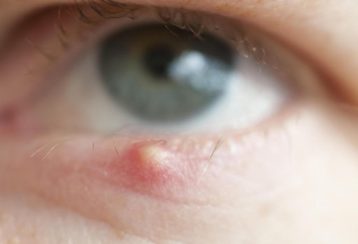 眼皮上长小疙瘩是怎么回事？应当如何预防眼皮长疙瘩？