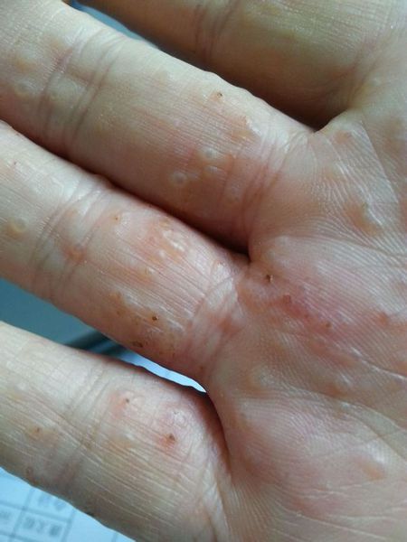 手上起小水泡(手上起小水泡不痛不痒怎么回事)