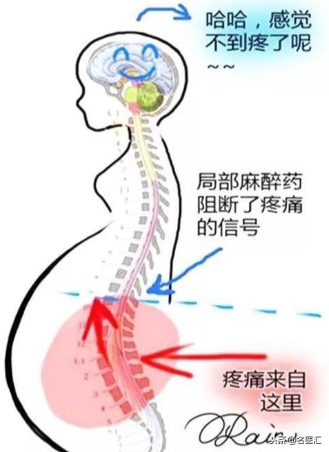 一次性鎮痛泵多少錢一個無痛分娩時代到來