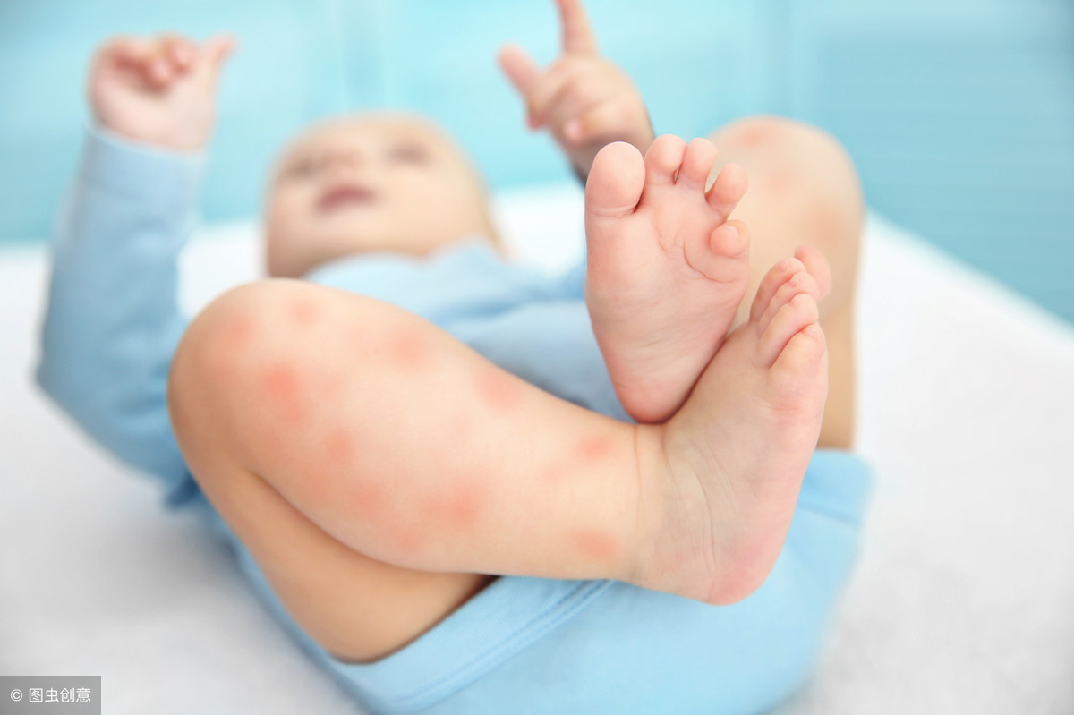 宝宝痱子和湿疹怎么区分图片