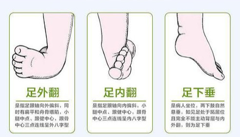 邱医生，我总觉孩子的脚与腿有问题！看看是啥呢？