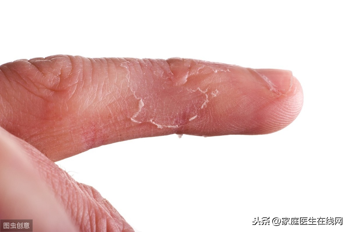 手脱皮是什么原因导致的？通常是缺乏这种维生素，补一补就好了-第1张图片