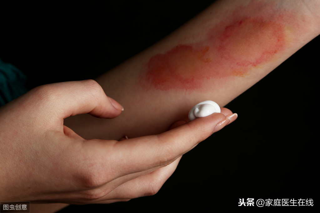 皮肤烫伤了，该怎么处理？教你几个方法来急救