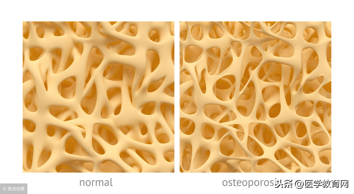 骨质疏松的不同症状如何分别用药！内含5组联合用药方法！
