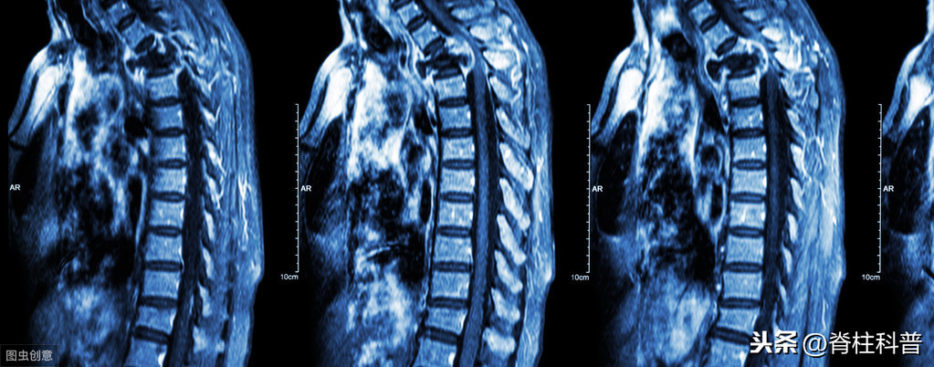 X光看不清，CT辐射大，腰突只想做最贵的核磁共振，为什么不行？