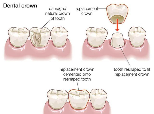 牙坏到什么程度要做根管治疗？为什么做完还要在花钱戴牙冠？