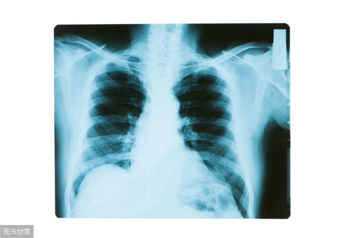 X光片、CT、核磁有什么区别？看病用哪个好？一个比喻你就明白了