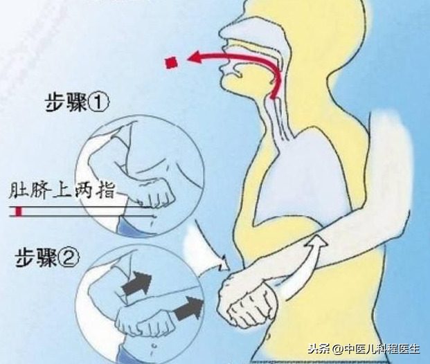 宝宝气管呛了异物怎么办？海姆立克法，宝妈宝爸们需要掌握