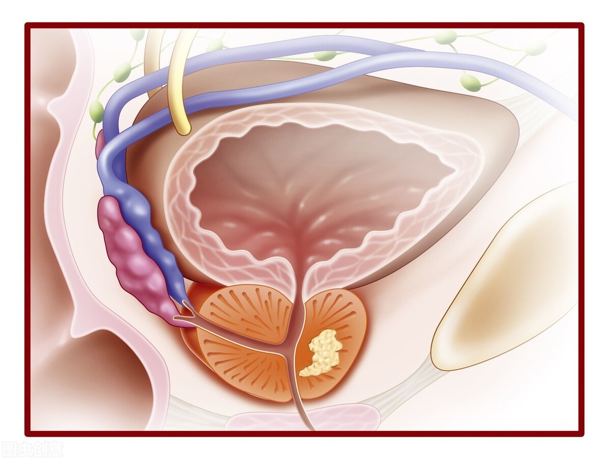 前列腺增生伴鈣化是什麼意思(體檢報告上出現) - 百百科