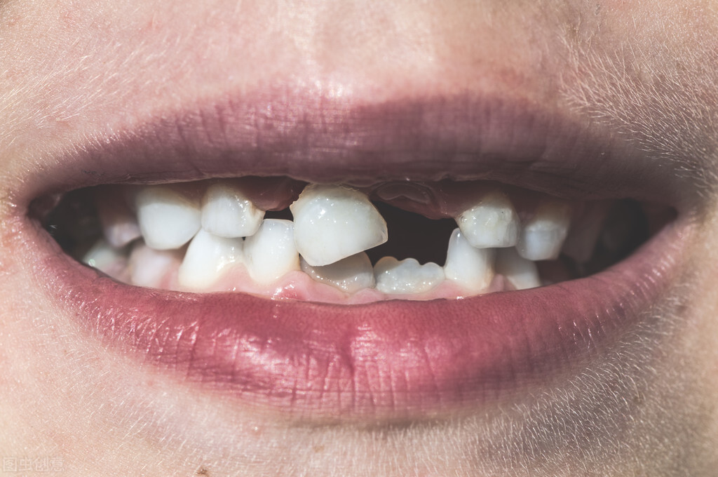 种植牙和烤瓷牙：你更适合哪个？牙科医生告诉你两者的利与弊
