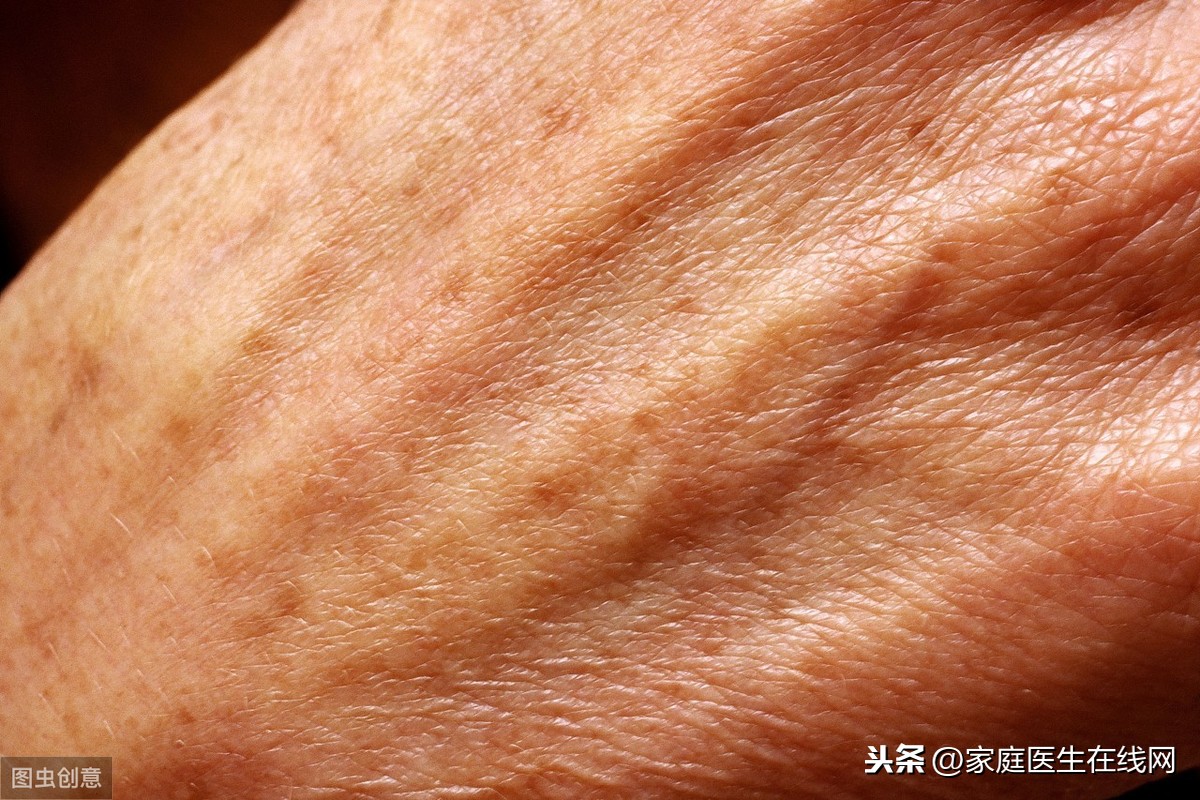 老年斑需不需要治疗？做好这2点，可以淡化