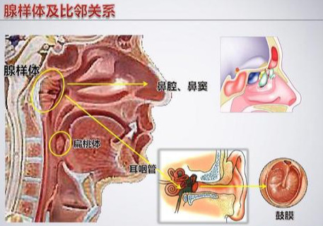 手术治疗儿童腺样体肥大，也未必一劳永逸，该怎么办？