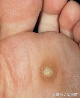 跖疣与性有关系吗(跖疣误认为鸡眼？跖疣同尖锐湿疣一样是HPV感染病毒所致！)
