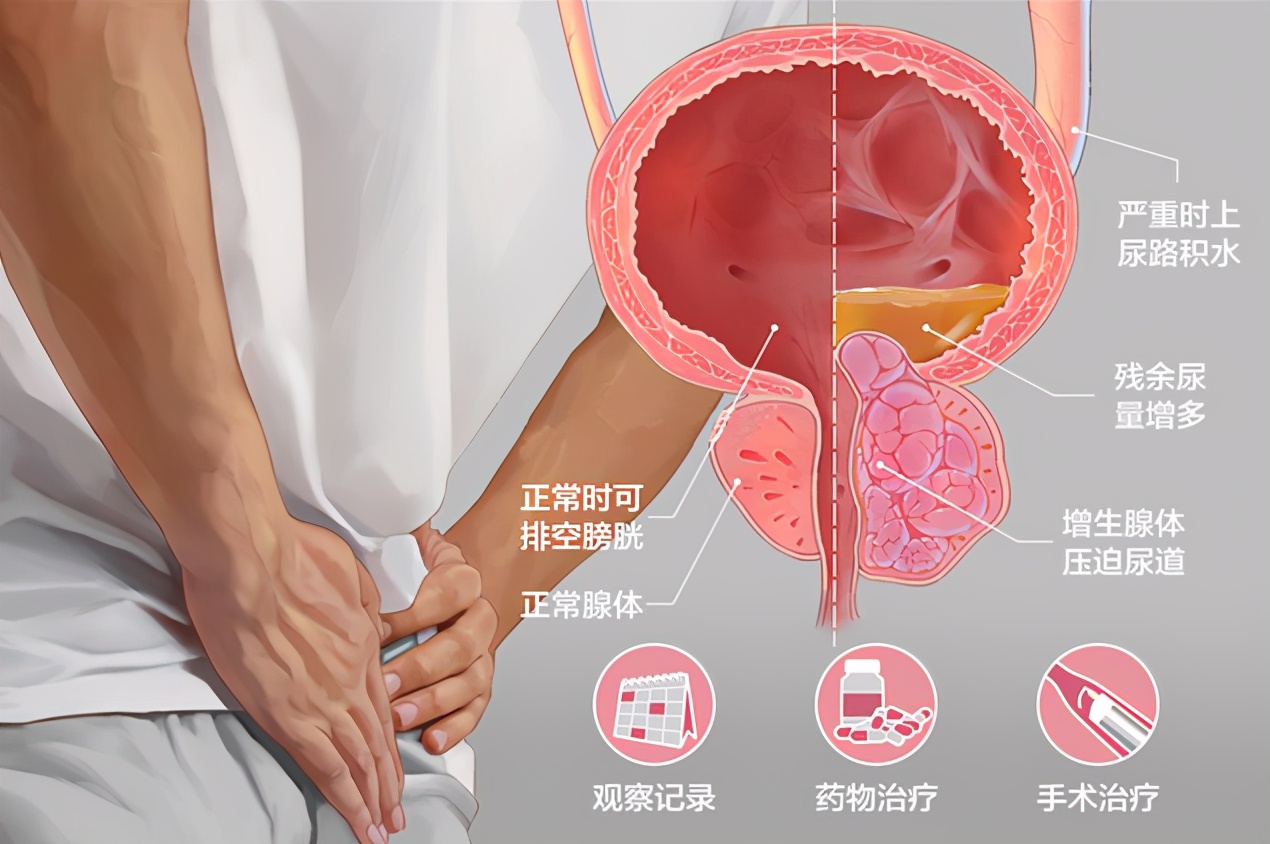 炎症会使神经感降低,尿意中枢处于兴奋状态,所以就会产生尿不尽.