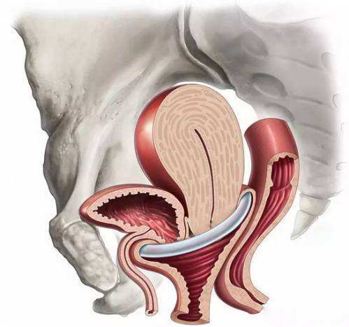 子宫脱垂到底是什么？