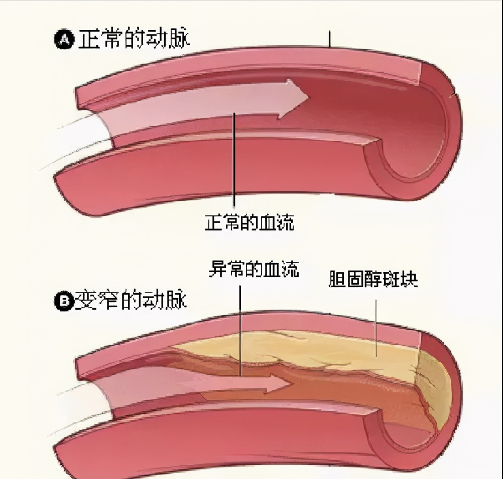 动脉粥样硬化闭塞怎么办？专科医生告诉您这样治疗效果好