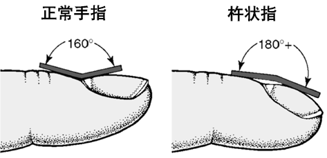 作为疾病较典型体征，杵状指的出现，预警着肺部健康出现问题