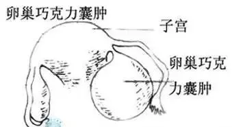 手术都做干净了,为什么巧克力囊肿还会复发?