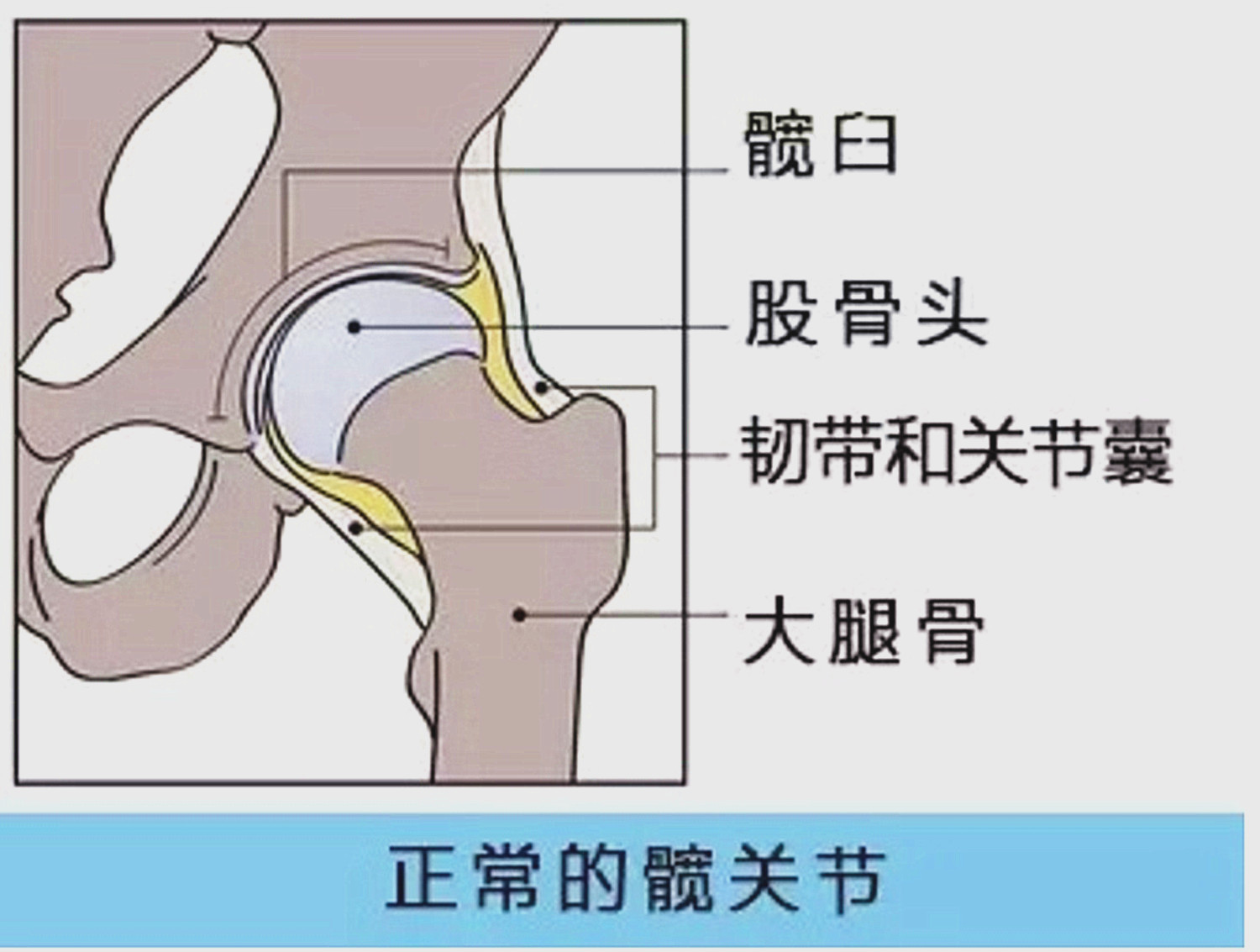 ▼什么是发育性髋关节发育不良