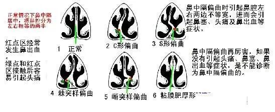 鼻中隔偏曲矫正——功能与美观可以二者兼得