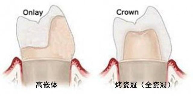 牙齿烂了之后，做嵌体修复好吗？来看看牙科医生的真建议