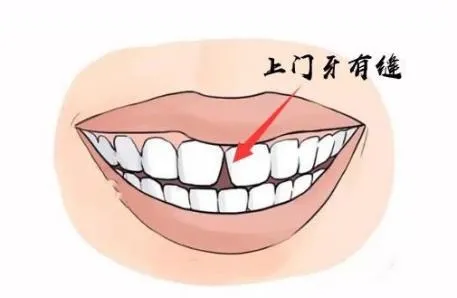 6-12岁换牙时间和换牙期问题大盘点!孩子一口好牙关键就在这几点
