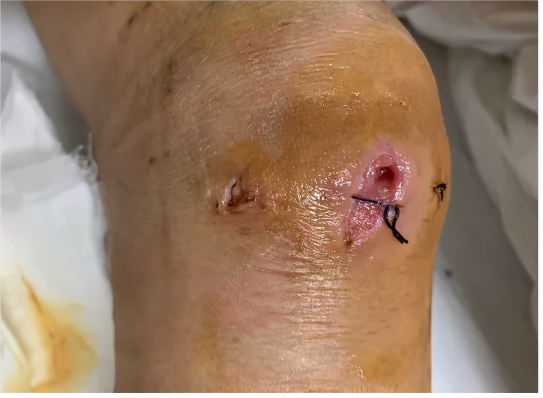 世界上最远的距离,是口腔的细菌长途感染到了膝盖