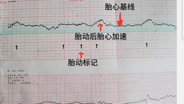 从这个孕周开始要做胎心监护，五个问题带你了解“胎监”，别大意