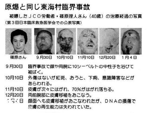 东海村核事故：最残忍的死亡方式，全身DNA断裂，皮消肉融
