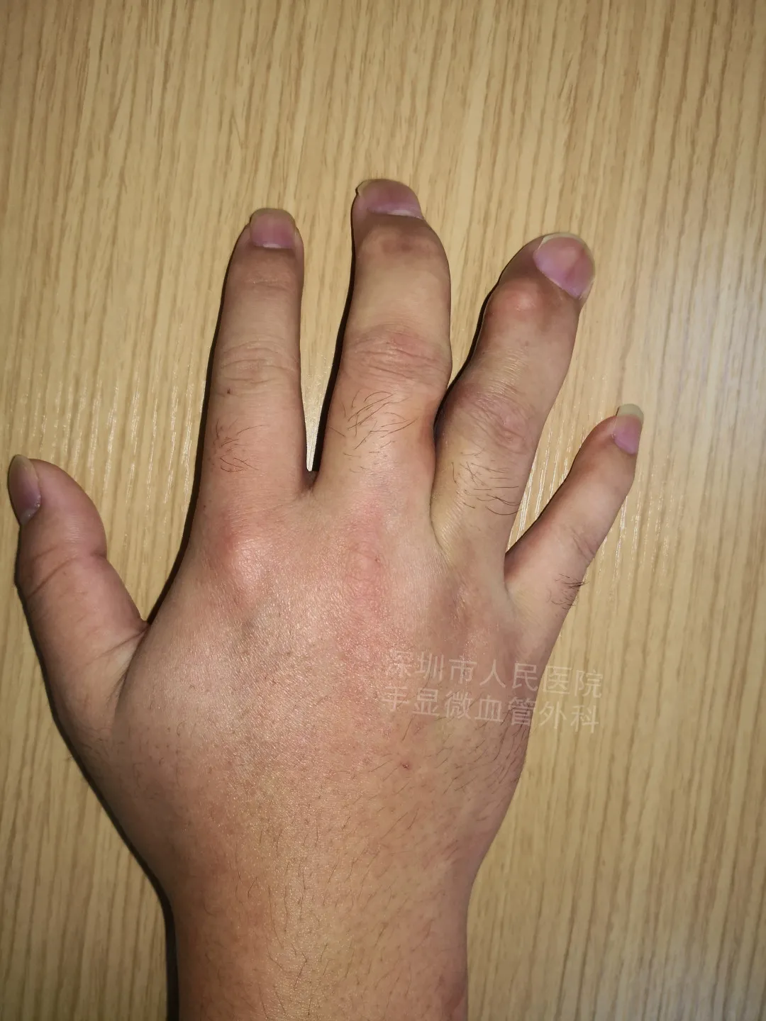 得了这病，12岁男孩手指比香蕉还粗！7种常见的手部畸形，家长们要注意