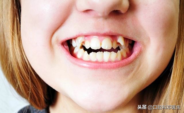你觉得这个好看吗?2长期的牙齿发炎是会影响恒牙的发育和正常萌