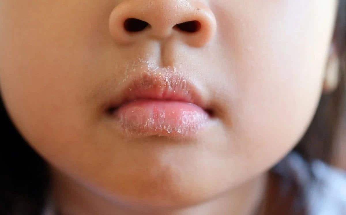 天气干燥,宝宝皮肤容易起皮,该怎样护理?快试试这四招