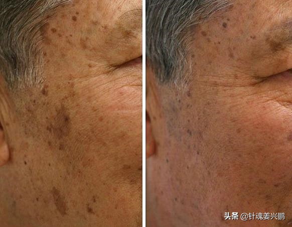 脂溢性角化病图片(40岁男女) - 赤虎壹号