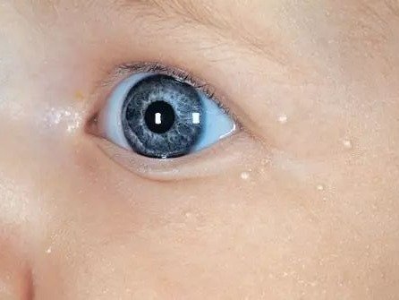 15种婴儿常见皮肤病详解!
