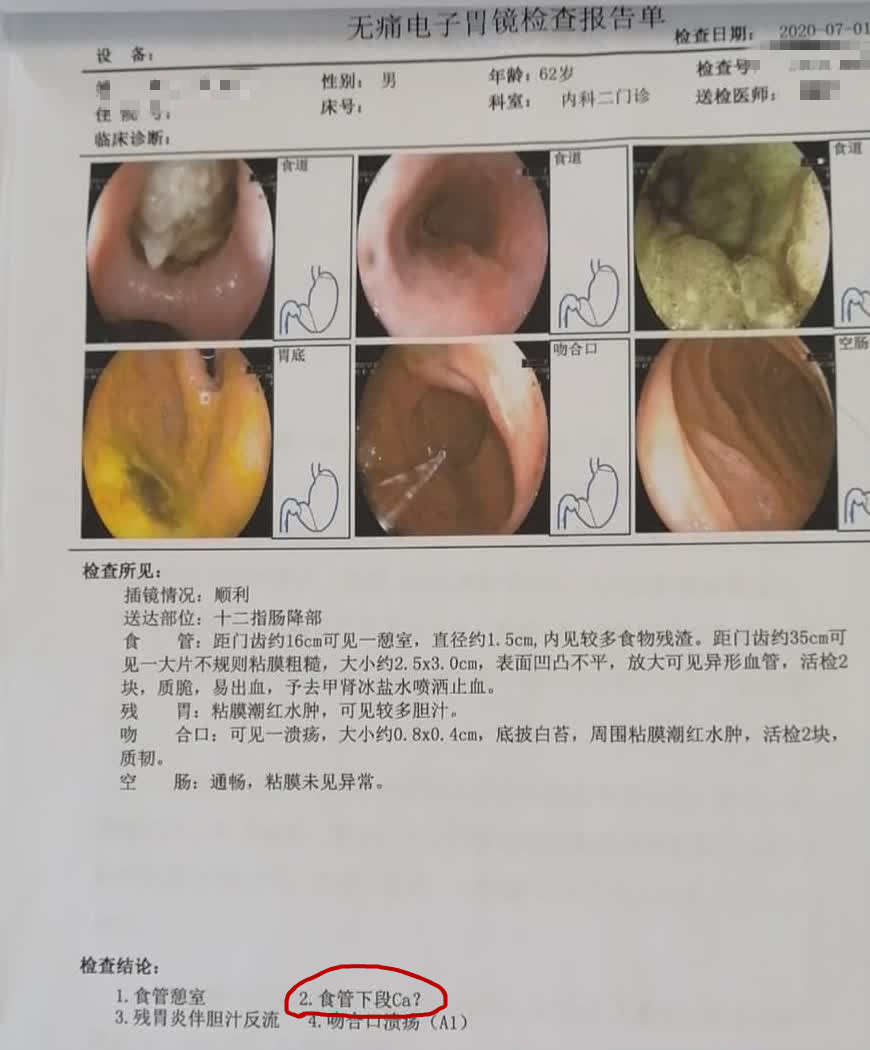 食道癌死前一天症状图图片