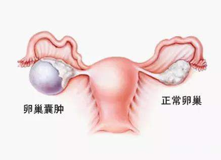 早衰！不孕！更年期提前！卵巢囊肿手术对卵巢功能影响多多