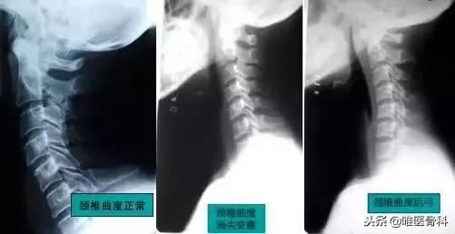 毁气质的 “脖子前倾”,明星也逃不过,医生送你4招拯救!