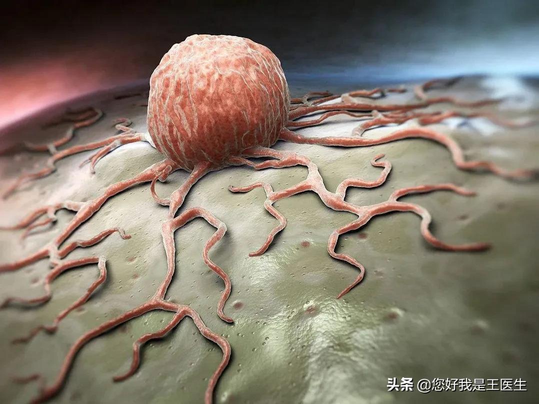 脂肪瘤如何消除？如何做到预防？