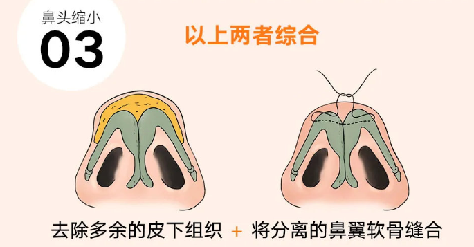 鼻头肥大怎么办，徒手按摩真的可以让鼻子变小吗？