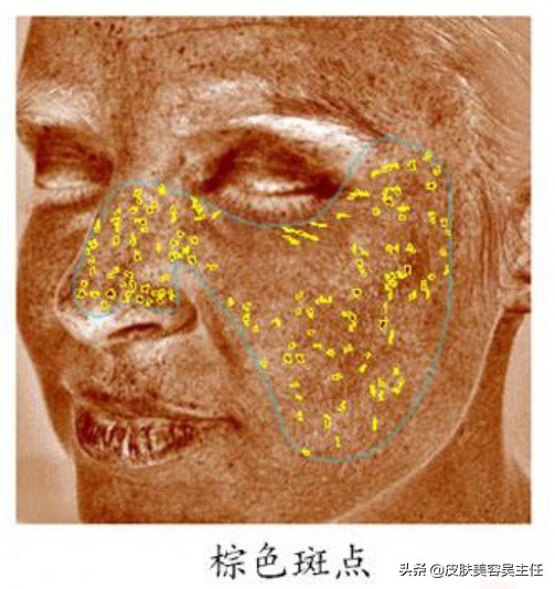 如何看待检测皮肤的visia检测结果？