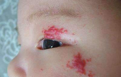 1,网格状胎记这种胎记称为网状青斑,是由局部血管收缩能力异常引发